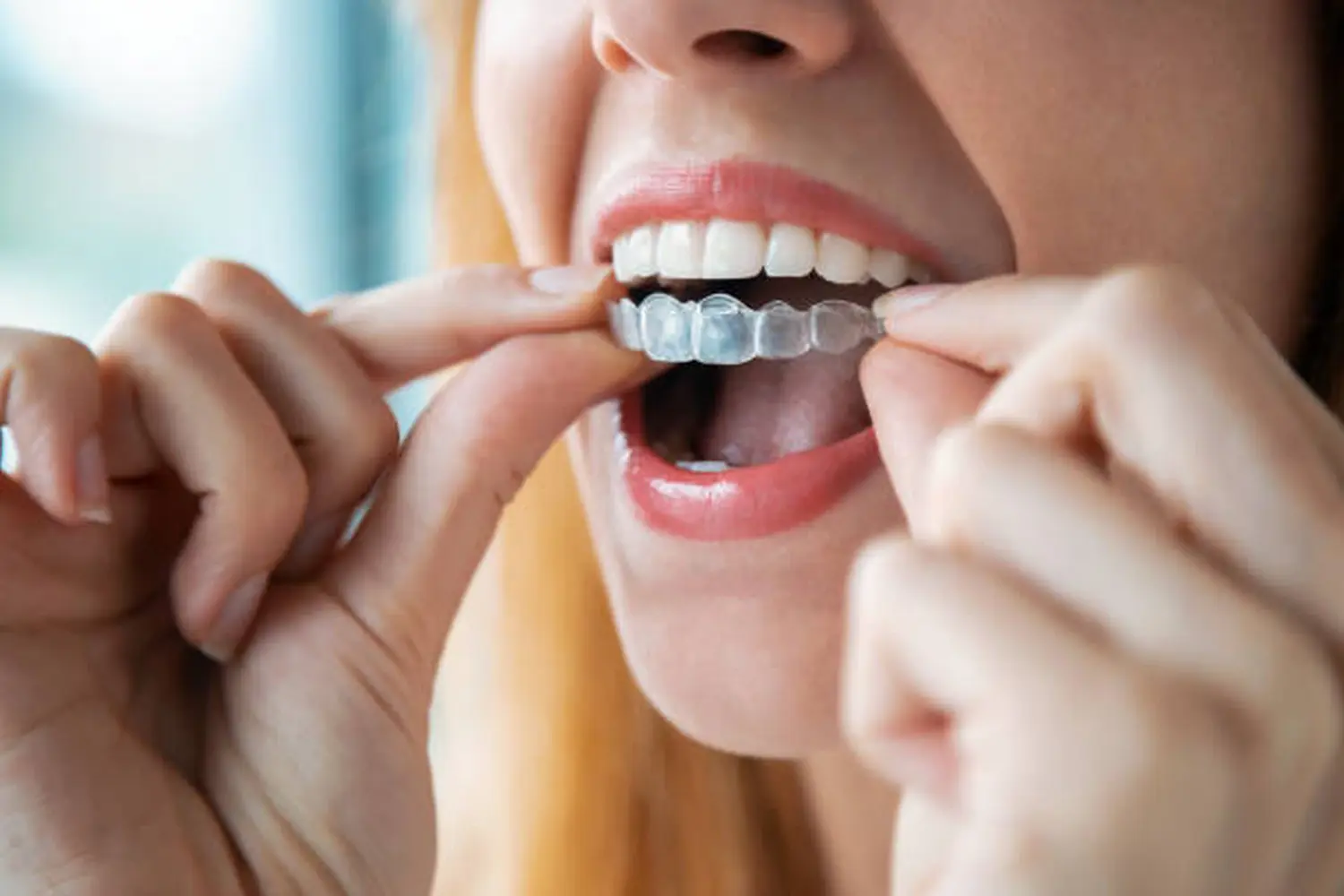 Aligner-Therapie von Zahnarztpraxis Bhatti